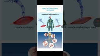 Amyotrophic lateral sclerosis [upl. by Oruntha]