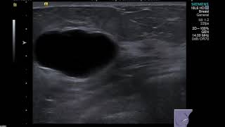 Breast Ultrasound cyst [upl. by Ogren102]