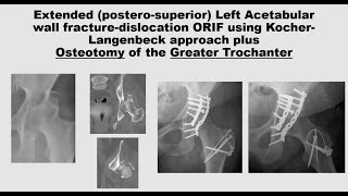 Tension band and cerclage wiring techniques for fracture fixation [upl. by Brigitte293]