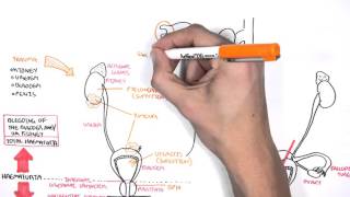 Causes of Haematuria [upl. by Toni156]