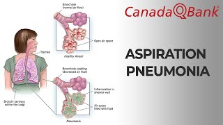 Aspiration Pneumonia [upl. by Asiil963]