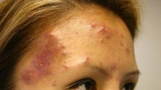 The Acne Practice severe case 5 [upl. by Lesslie]