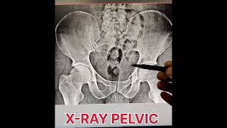 fracture of pubic rami radiology shortvideo [upl. by Immaj]