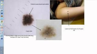 Dermoscopy Made Simple  Reed nevus [upl. by Arthur]