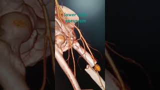 CT lower limb aneurysmctangiography ctscan ctcontrst medical ctscan trauma [upl. by Caruso548]