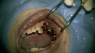 Straumann NC RN WN place in posterior mandible 4 [upl. by Anaiviv878]