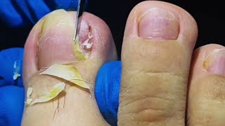 Relief in Minutes Fixing Ingrown Toenail and Toenail Fungus Surgery [upl. by Aztinad435]