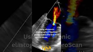 Meet the FibroScan [upl. by Serena]