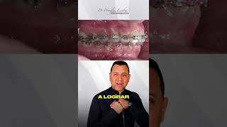 CASO LIZ PLEITEZ😁🦷 [upl. by Bethel318]