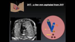 Three Vessel Tracheal View A Review of Normal and Abnormal Findings [upl. by Slaohcin]