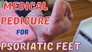 Satisfying Medical Pedicure for Psoriatic Feet [upl. by Rother]