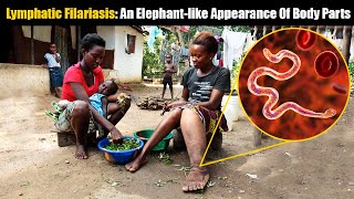 Elephantiasis Or Lymphatic Filariasis An Elephantlike Condition That Afflicts Millions Worldwide [upl. by Beatrice]