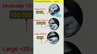 Pericardial effusion دل کے گرد پانی کا جمع ھونا Estimation of Pericardial EFFusion through ECHO [upl. by Sidoney]