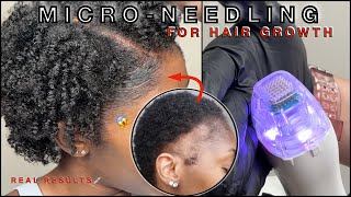 MICRONEEDLING  PRP FOR EDGE GROWTH 💉 FULL PROFESSIONAL JOURNEY  TRACTION ALOPECIA 🚨  FAQ [upl. by Nitsirt]