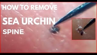 How to remove sea urchin spine [upl. by Ostap36]