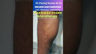 15824 Foam Sclerotherapy treatment for varicose veins Varicose veins treatment before SSC GD [upl. by Junius849]