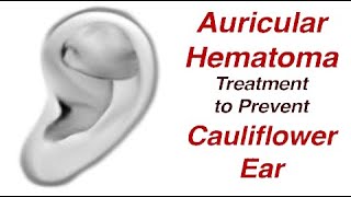 Auricular Hematoma Treatment to Prevent Cauliflower Ear [upl. by Elleon299]