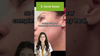 Hormonal Acne Vs Fungal Acne acne shorts [upl. by Ahsemac]