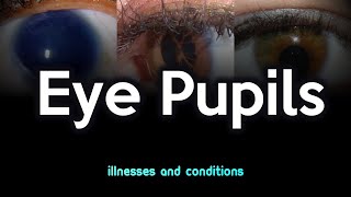 Eye Pupils Illnesses and Conditions [upl. by Hellah]