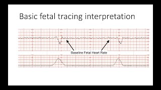 Interpreting Intrapartal fetal heart rate tracings [upl. by Besnard]