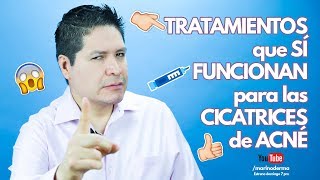 TRATAMIENTOS QUE SÍ FUNCIONAN EN CICATRICES DE ACNÉ [upl. by Ecyt]