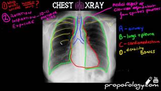 LEARN to Read a Chest Xray in 5 minutes [upl. by Darcia]