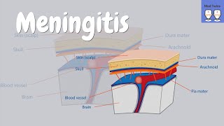 Meningitis bacterial vs viral symptoms Kernigs sign clinical clues meningococcal infection [upl. by Anahsak306]