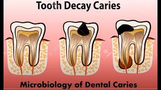 Histopathology of dental caries Functions of saliva [upl. by Haymo]