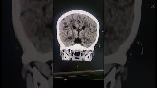 Corpus Callosum Agenesis  Radiology [upl. by Trumaine]