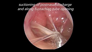 Endoscopic Myringotomy Suctioning of Middle Ear Mucous and Grommet Insertion [upl. by Hayilaa]