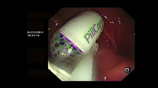 OGD ASSISTED CAPSULE ENDOSCOPY [upl. by Illa]