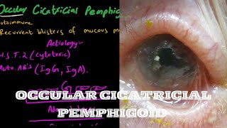 Ocular Cicatricial Pemphigoid  mucous membranous pemphigoid [upl. by Ardrey]