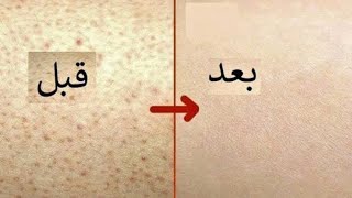 روتين علاج جلد الوزه من اول استخدام مرهم ديبروساليك وكارباميد [upl. by Sirronal965]