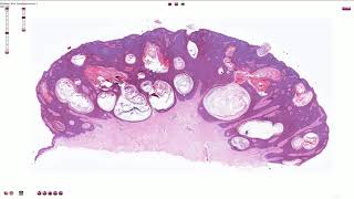 Seborrheic Keratosis Including Variants  Histopathology [upl. by Aenel]