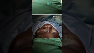 Ethnic nose rhinoplasty by dr Nihat Kaya nonsurgicalrhinoplasty newnose rhinoplasty ethnicnose [upl. by Athena]