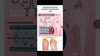 Antiphospholipid Antibody Syndrome [upl. by Mullac]