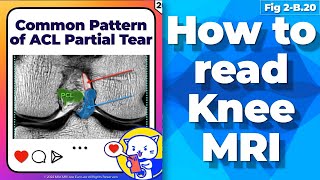 Fig 2B20 Common pattern of the ACL Partial Tear [upl. by Whitaker451]