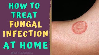 HOW TO TREAT SKIN FUNGAL INFECTION INFECTION AT HOME TINEA RINGWORM REMEDIES HOW TO CURE [upl. by Rooker]