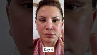 Facelift Patients 3 Week Healing amp Recovery Process [upl. by Kameko410]