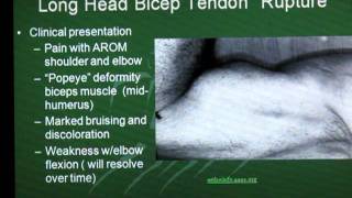 Long Head Biceps Tendon Rupture [upl. by Ahsenroc]