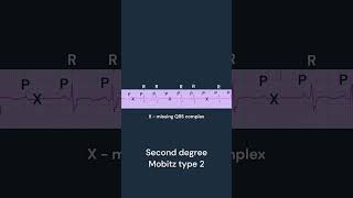 Second degree Heart Block Type 2 [upl. by Zackariah]