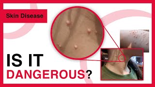 Molluscum contagiosum  Symptoms Risk factors Treatment Prevention  Dermatology [upl. by Tankoos]