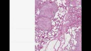 Histopathology Lung Tuberculosis [upl. by Tnecniv]