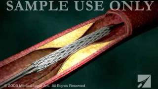 Stent Angioplasty  ANC00202 [upl. by Marybelle653]