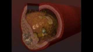 Chelation Therapy Video [upl. by Hakvir]