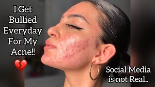 I Get Bullied Everyday Because of My ACNE 💔  Reality of Social Media [upl. by Elissa]