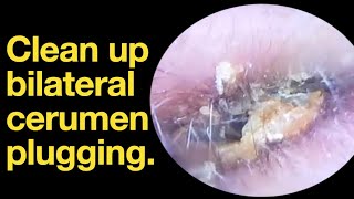 Clean up bilateral cerumen plugging ear wax removal  ear cleaning  ASMR  relaxation  relax [upl. by Conney]