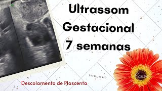 Ultrassom Gestacional  7 semanas  Descolamento de placenta [upl. by Norrek]