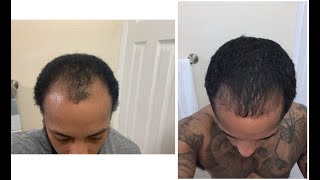 Growing my hair back I WAS GOING BALD [upl. by Eibbed]