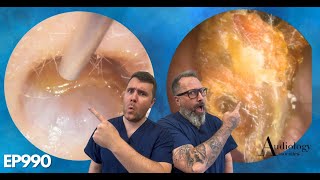 HUGE POLYPS PEELS amp MASSIVE EAR WAX PLUGS  EP990 [upl. by Carrnan]